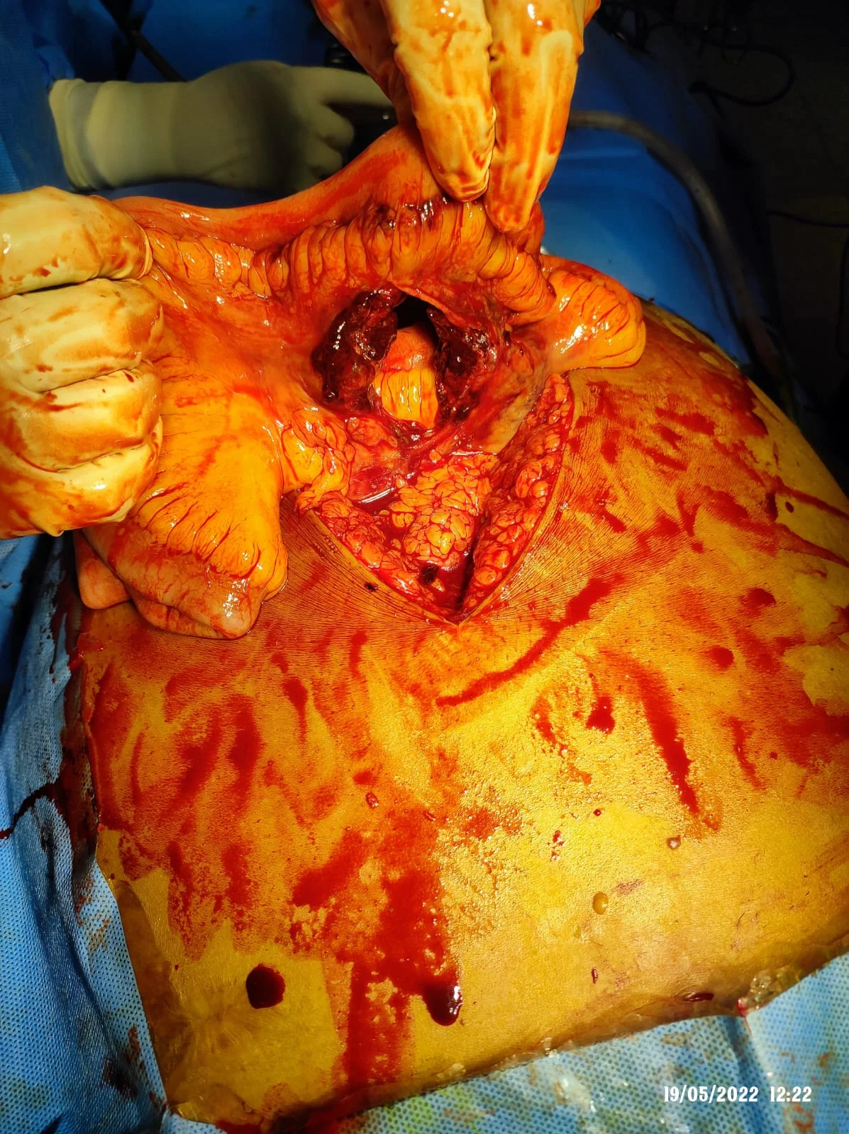 Surgery