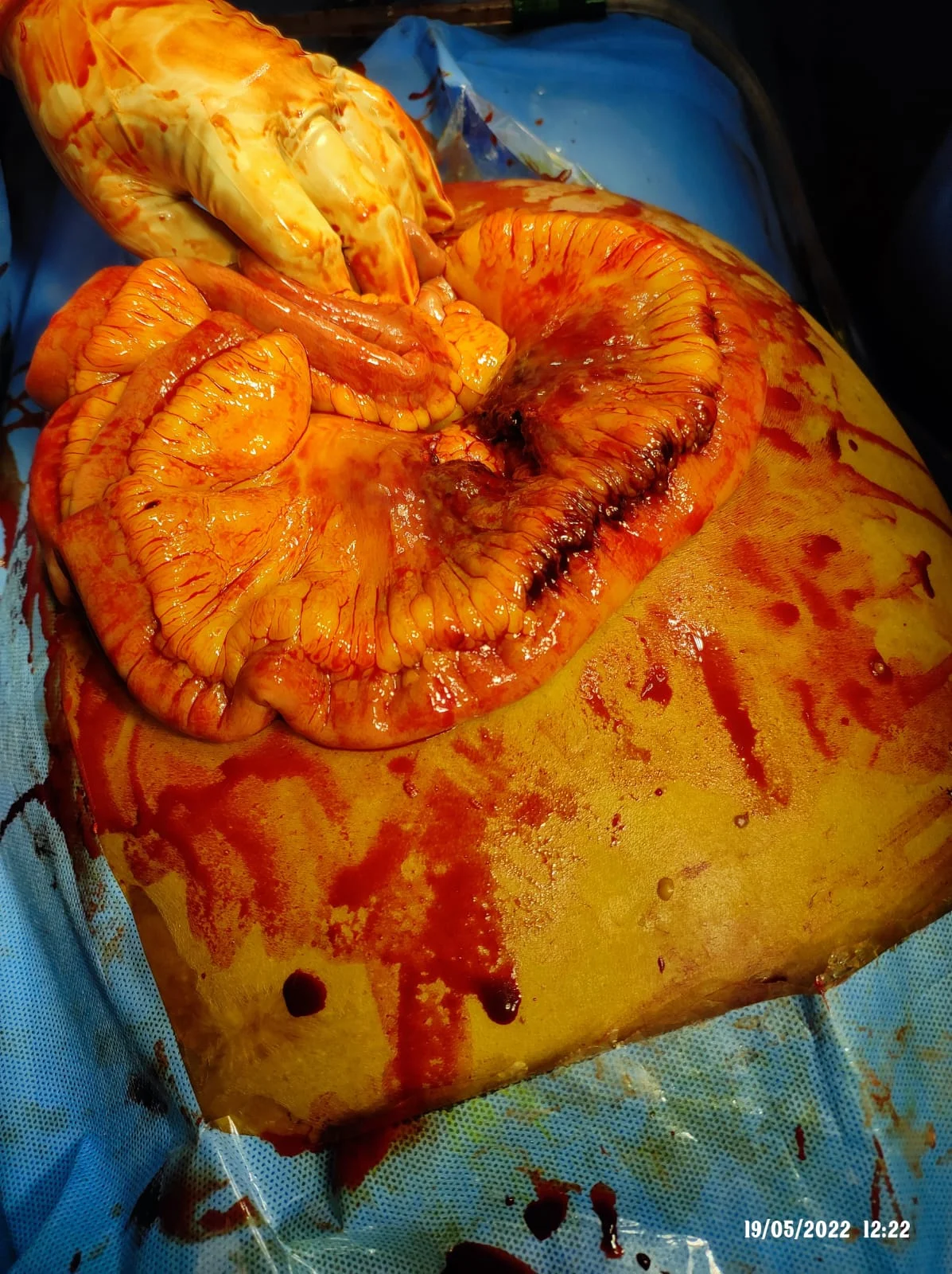 Surgery