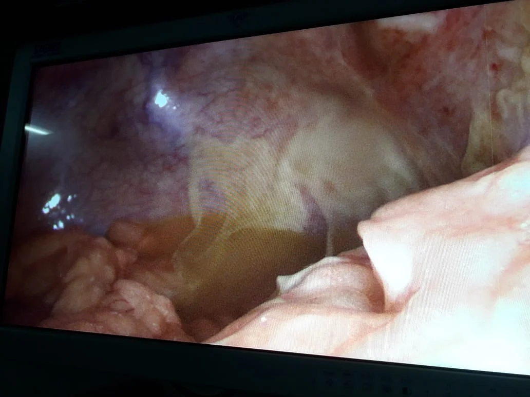 Surgery