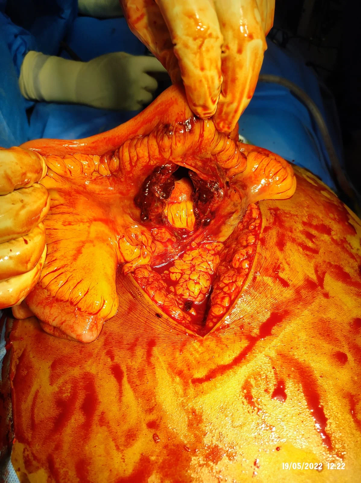 Surgery