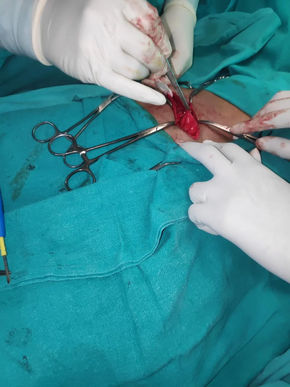 Surgery