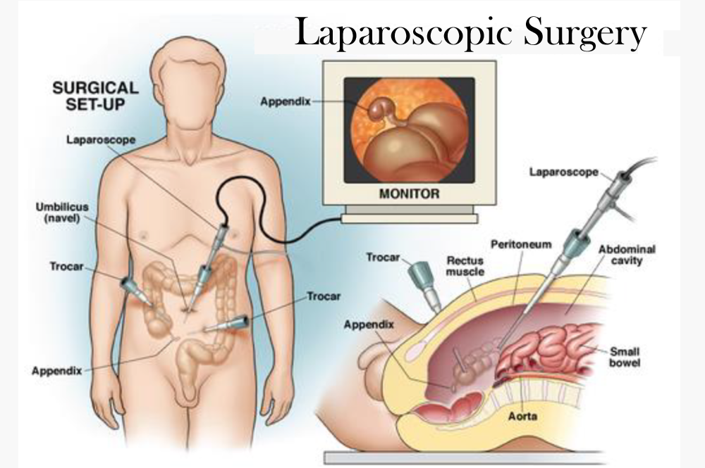 Laparoscopic Surgery