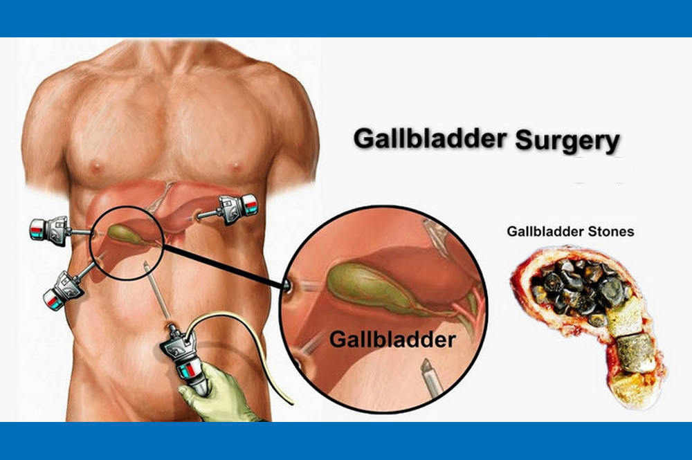 Gall Bladder Surgery