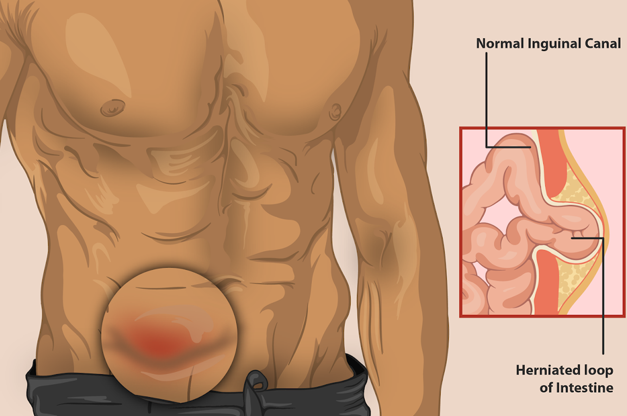 Hernia Surgery