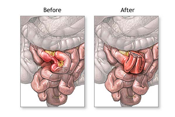 Intestinal Surgery